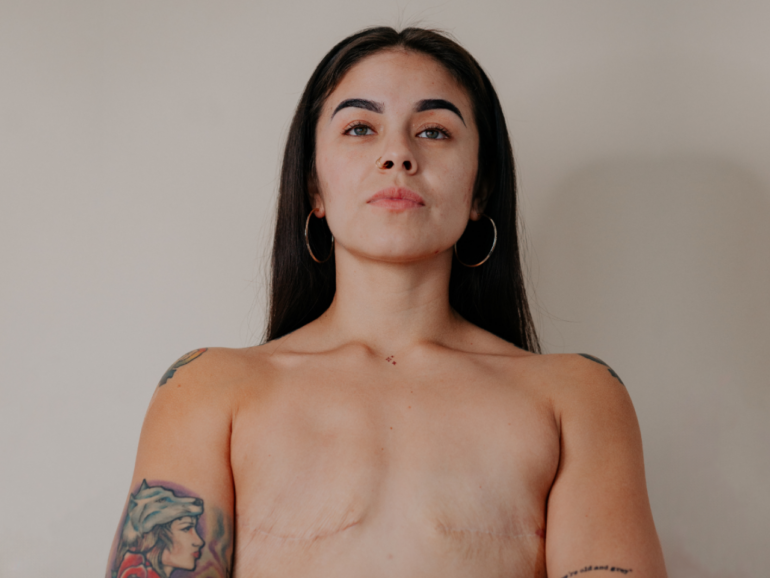 Una mujer se somete a una mastectomía preventiva: «Mi autoestima no depende de la apariencia»