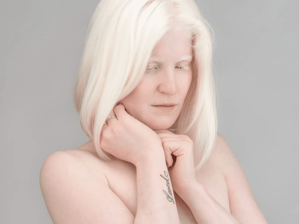 Nieves endured abuse and bullying growing up with albinism, but overcame her struggles to become an actress on screen.